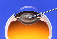 レンズ白内障手術その１