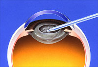 レンズ白内障手術その2