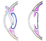 レンズ白内障手術その5