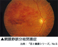 網膜静脈分枝閉塞症